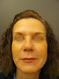 Under Eye Rejuvenation