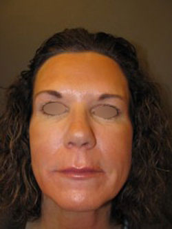 Under Eye Rejuvenation