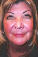 Eyelid Surgery