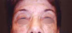Eyelid Surgery
