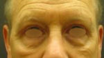 Eyelid Surgery