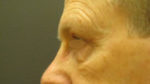 Eyelid Surgery