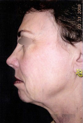 Facelift