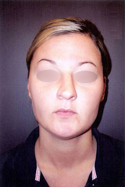 Nose Surgery