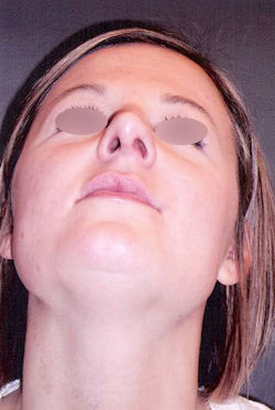 Nose Surgery
