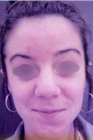 Nose Surgery