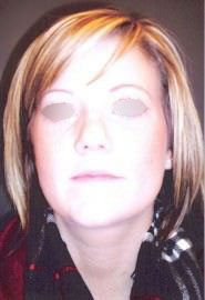 Nose Surgery