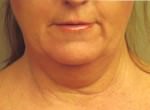 Neck Lift