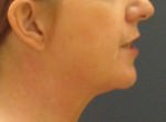 Neck Lift