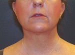 Neck Lift