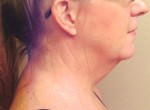 Neck Lift