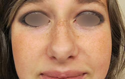 Nose Surgery