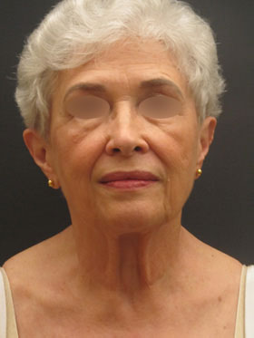 Facelift
