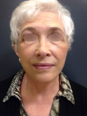 Facelift
