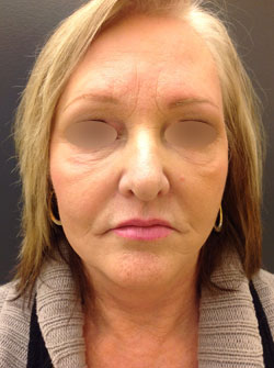 Facelift