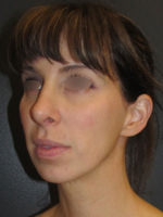 Restylane and Perlane