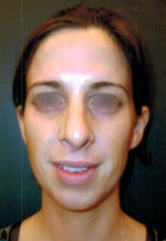 Restylane and Perlane