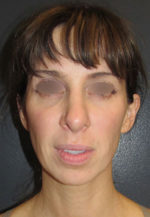 Restylane and Perlane