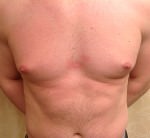 Gynecomastia