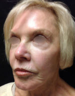 Exilis