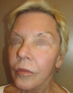 Exilis