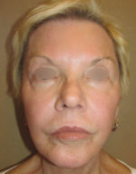 Exilis