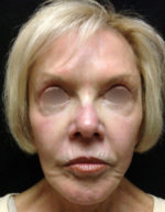 Exilis