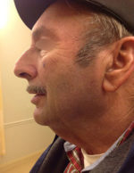 Neck Lift