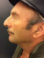 Neck Lift