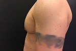 Gynecomastia