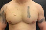 Gynecomastia
