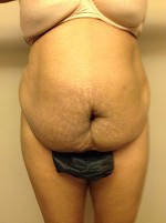 Liposuction