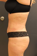 Liposuction