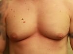 Gynecomastia