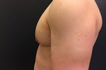 Gynecomastia