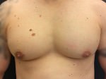 Gynecomastia