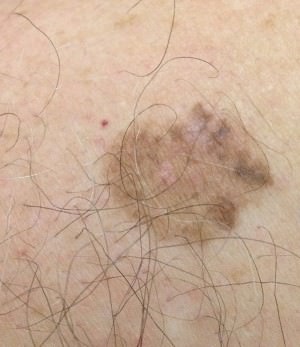Malignant Melanoma
