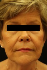 Restylane and Perlane