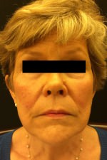 Restylane and Perlane