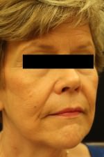 Restylane and Perlane