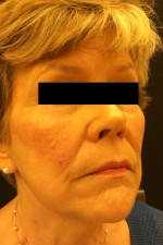 Restylane and Perlane