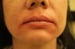 Juvederm