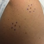 Dysplastic Nevus