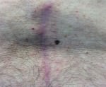 Dysplastic Nevus