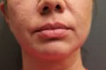 Juvederm