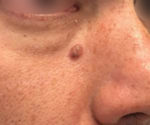 Basal Cell Carcinoma