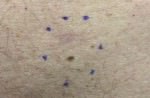 Dysplastic Nevus