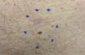 Dysplastic Nevus
