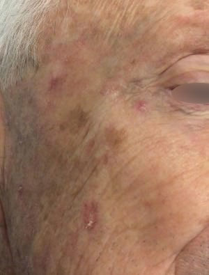 Squamous Cell Carcinoma