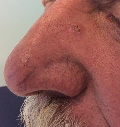 Basal Cell Carcinoma